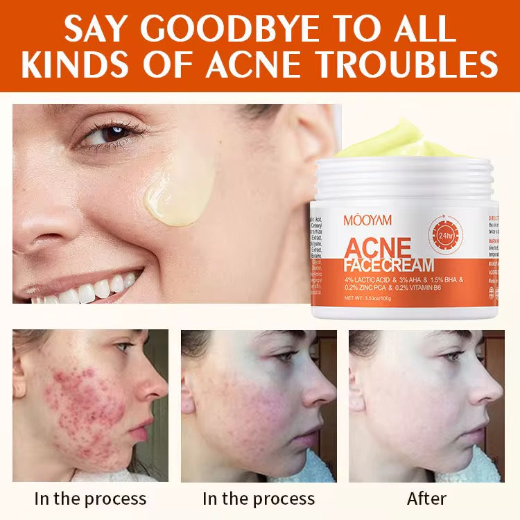 Salicylate Repair Acne Treatment Cream Smallpox Diluting