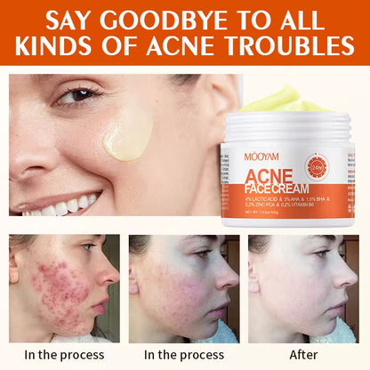 Salicylate Repair Acne Treatment Cream Smallpox Diluting