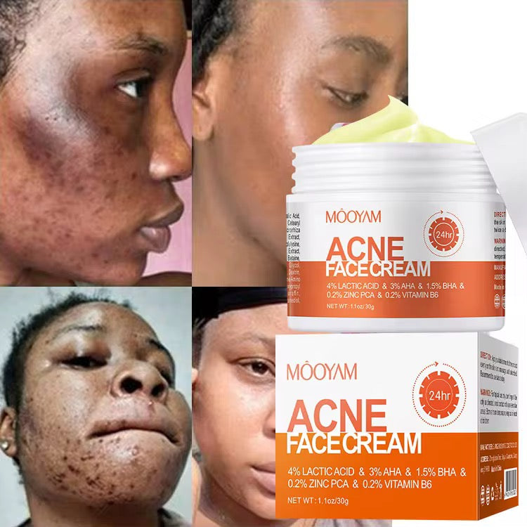 Salicylate Repair Acne Treatment Cream Smallpox Diluting
