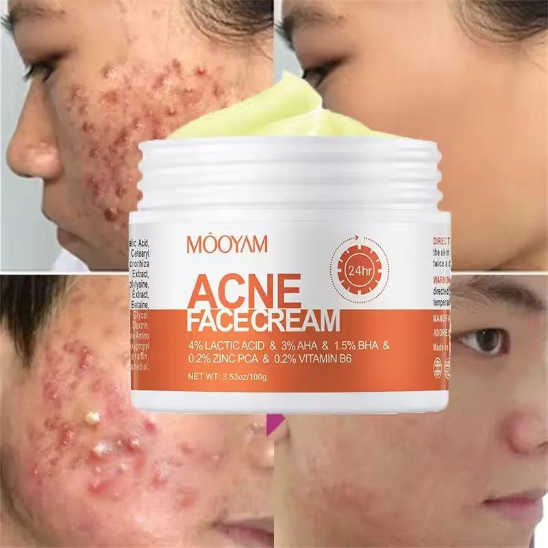 Salicylate Repair Acne Treatment Cream Smallpox Diluting